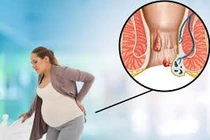 Ảnh hưởng của trĩ đến sản phụ và thai nhi