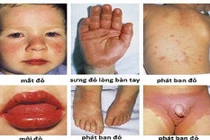 Kawasaki: Căn bệnh nguy hiểm với trẻ em