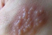 Nổi bọng nước đắp lá chảy mủ vàng