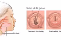 Giải pháp cải thiện viêm thanh quản kéo dài cực hiệu quả từ sản phẩm thảo dược