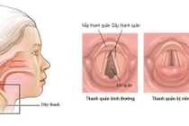 Giải pháp cải thiện viêm thanh quản kéo dài cực hiệu quả từ sản phẩm thảo dược