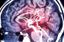 Ảnh chụp cộng hưởng từ MRA mạch máu trong não. Ảnh ScitechDaily