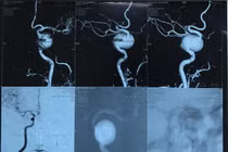  Túi phình mạch máu não: Những “quả bom nổ chậm”