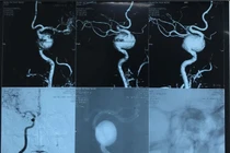  Túi phình mạch máu não: Những “quả bom nổ chậm”