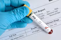 Chỉ số PSA với ung thư tiền liệt tuyến