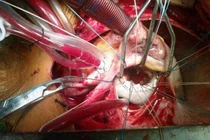 Hà Nội: Vỡ tim khi đang đi ô tô, người đàn ông được bác sĩ BV Việt Đức cứu sống