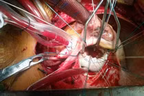 Hà Nội: Vỡ tim khi đang đi ô tô, người đàn ông được bác sĩ BV Việt Đức cứu sống