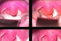 3 bệnh về họng hay gặp trong mùa lạnh