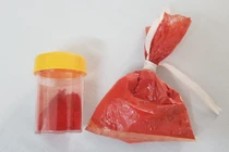 Tổn thương gan vì ăn sốt vang có phụ gia không rõ nguồn gốc