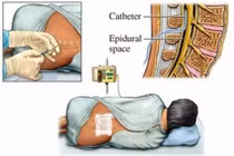 Tiêm Steroid ngoài màng cứng điều trị đau cổ và lưng