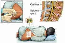 Tiêm Steroid ngoài màng cứng điều trị đau cổ và lưng