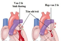Có cách nào chữa bệnh hở van tim? 