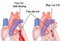 Có cách nào chữa bệnh hở van tim? 