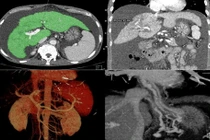 Can thiệp TIPS cứu bệnh nhân xơ gan cổ trướng
