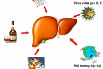 Tưởng chỉ đầy bụng nào ngờ ung thư gan