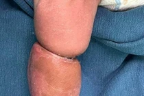 Giải vòng thắt dị tật bẩm sinh cho trẻ