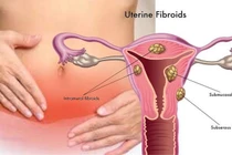 Tưởng rong kinh do đặt vòng hóa u xơ tử cung