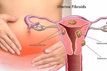 Tưởng rong kinh do đặt vòng hóa u xơ tử cung