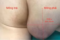 Chủ quan khiến u bã đậu hoại tử