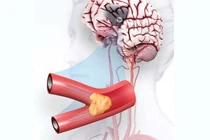 Đột quỵ thiếu máu não cục bộ - Nguyên nhân, triệu chứng và cách điều trị