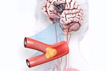 Đột quỵ thiếu máu não cục bộ - Nguyên nhân, triệu chứng và cách điều trị