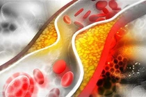 Cảnh báo 5 bệnh lý dễ gây đột quỵ  ở người cao tuổi - Hãy cẩn trọng!