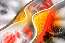 Cảnh báo 5 bệnh lý dễ gây đột quỵ  ở người cao tuổi - Hãy cẩn trọng!