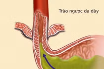 Thủ phạm gây trào ngược dạ dày thực quản