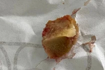 Gắp thành công mảnh xương lợn dài 1,5 cm nằm hơn một tháng trong phế quản 