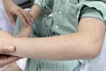 Rậm lông, béo mặt bất thường do lạm dụng corticoid