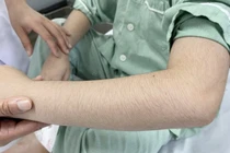 Rậm lông, béo mặt bất thường do lạm dụng corticoid