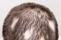 Điều trị rụng tóc từng mảng