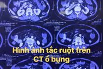 3 người phải mổ tắc ruột do ăn hồng ngâm