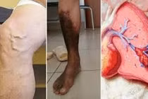 Nguy cơ mắc bệnh tim khi bị hẹp động mạch chân 