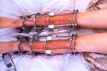 Phẫu thuật kéo dài chân cao thêm được bao nhiêu?