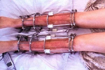 Phẫu thuật kéo dài chân cao thêm được bao nhiêu?