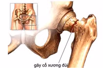 Hoại tử chỏm xương đùi có bơm tế bào gốc được không?