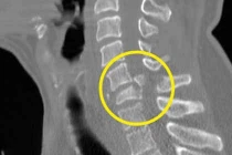 Gãy đốt sống cổ khổ suốt đời