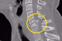 Gãy đốt sống cổ khổ suốt đời