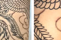 Mắc u mềm lây do xăm hình