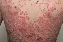 Không lạm dụng thuốc khi chữa vẩy nến	