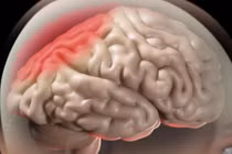  Phù não khi điều trị u