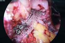 Nội soi đặt lưới nâng tử cung chữa sa sinh dục