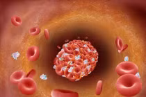 Cục máu đông có thể gây liệt