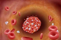 Cục máu đông có thể gây liệt