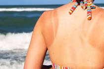 Tự khắc phục cháy nắng