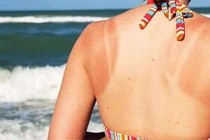 Tự khắc phục cháy nắng