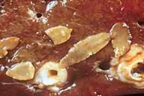 Gan xơ hóa do ký sinh trùng