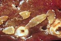 Gan xơ hóa do ký sinh trùng