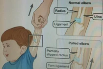 Trật khớp vì kéo trẻ một tay